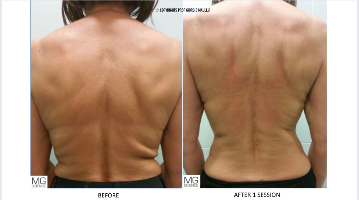 ATTIVA Back Treatment